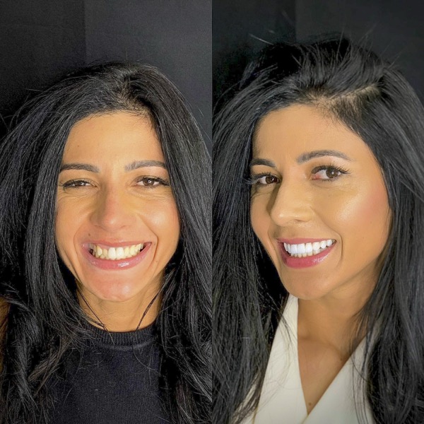 Antes e depois de tratamento dental Studio Orofacial