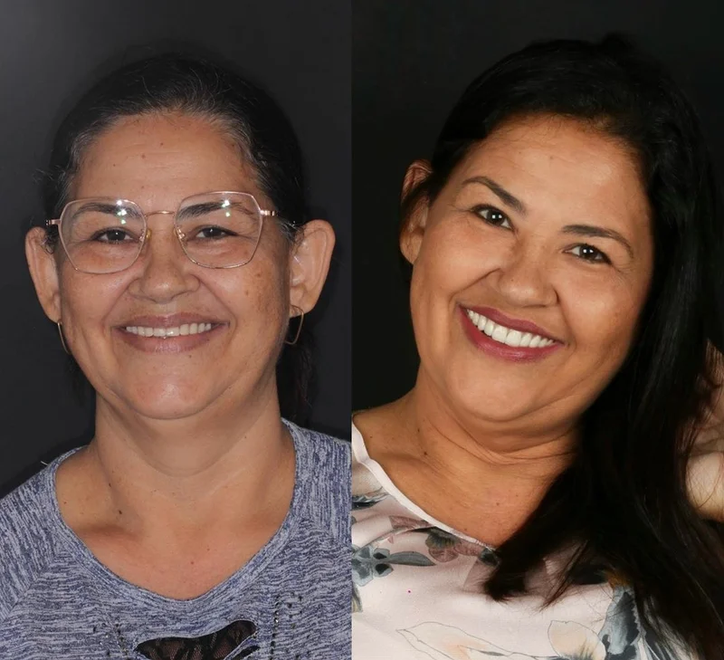 Dona Maria — antes e depois do protocolo sobre implante