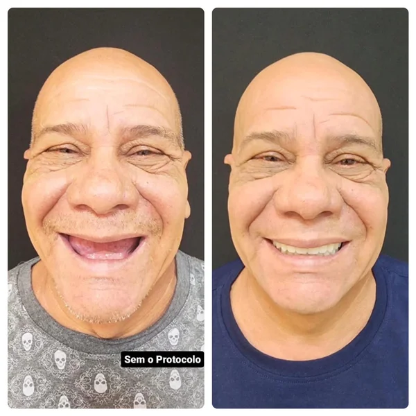 Antes e depois de protocolo sobre implante